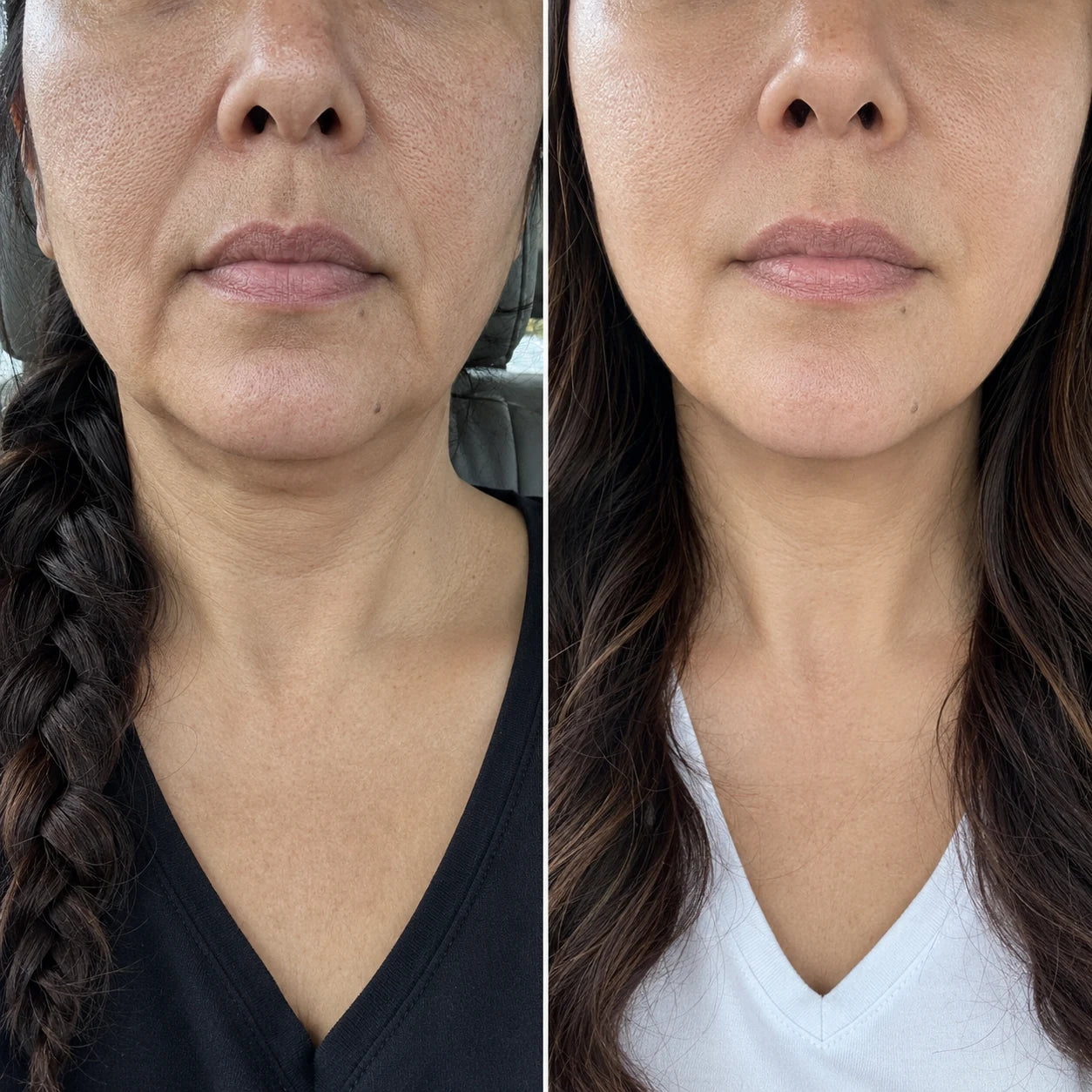 Teresa's jawline before and after